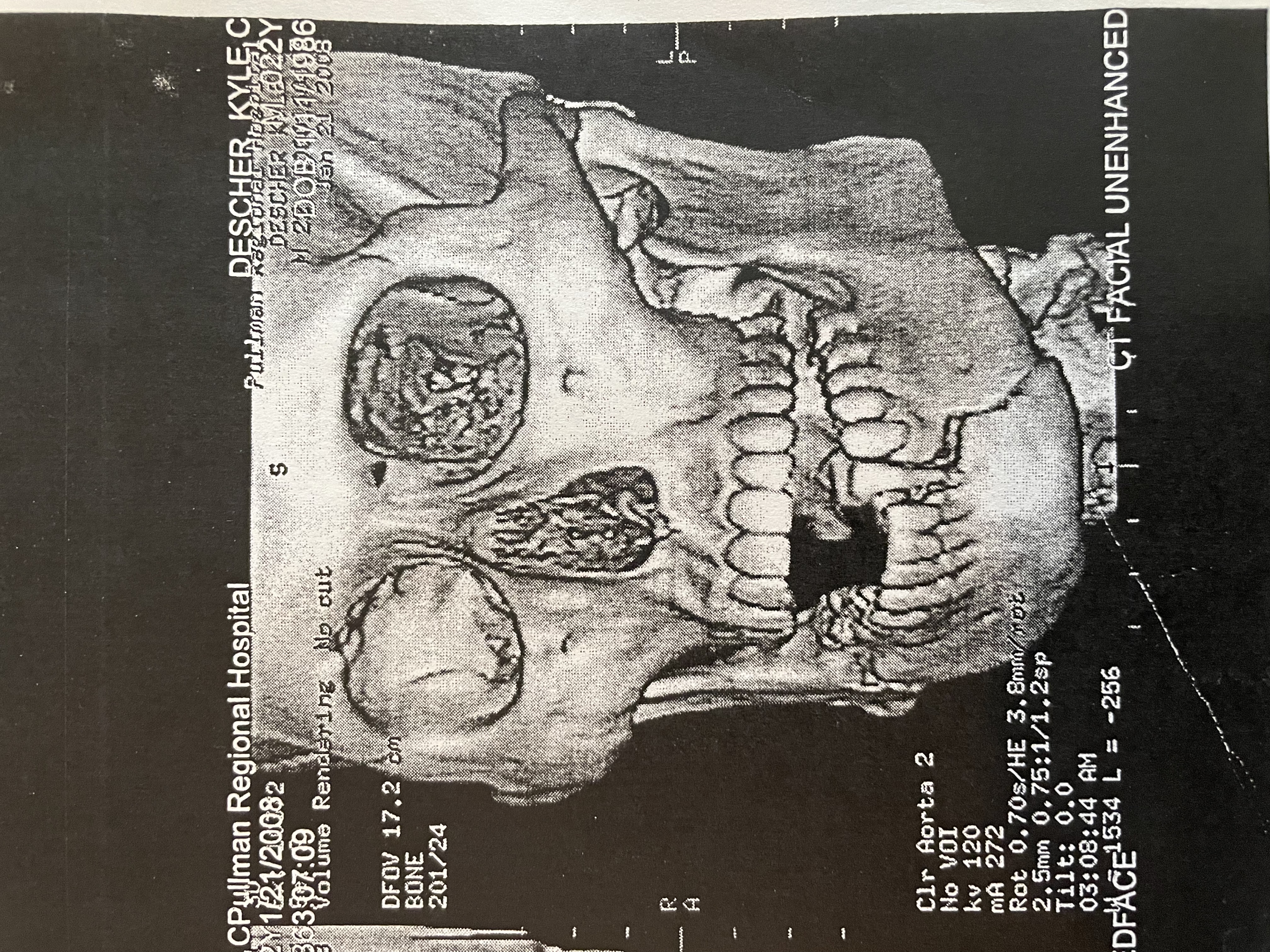 Medical imaging — jaw rebuilt with titanium plates after a violent attack